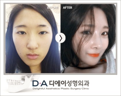 그 유명한 양악수술 | 인스티즈