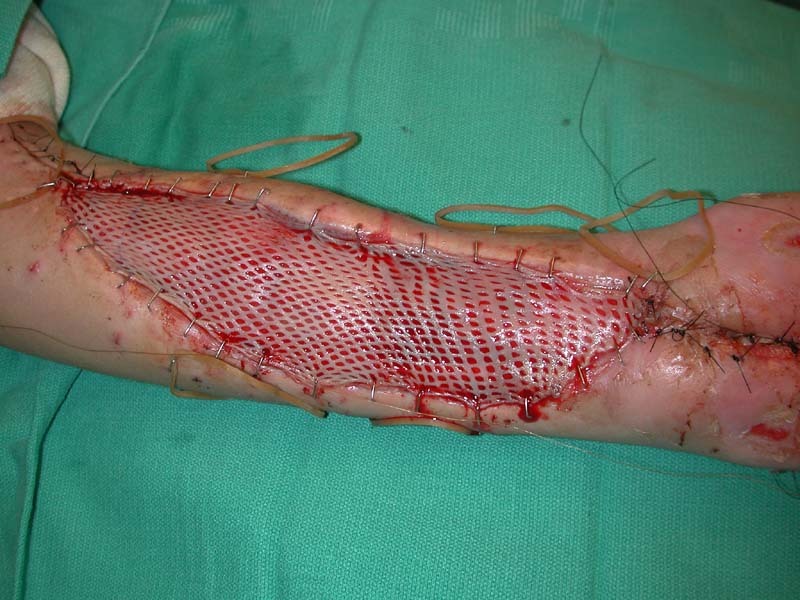 혐오))적나라함 주의)) 방울뱀에게 물린 사람의 치료과정 | 인스티즈