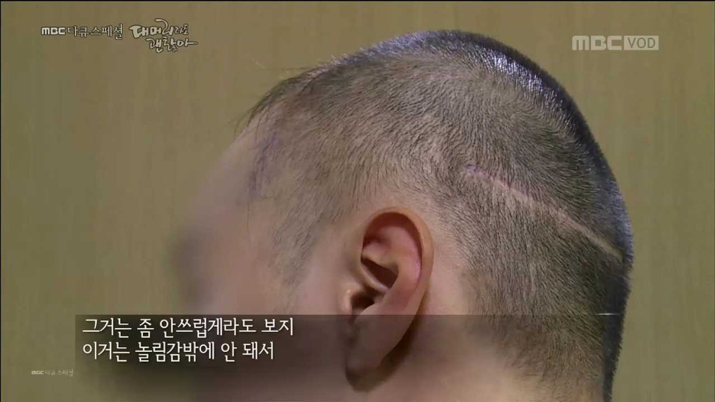 탈모 환자가 받는 스트레스... | 인스티즈